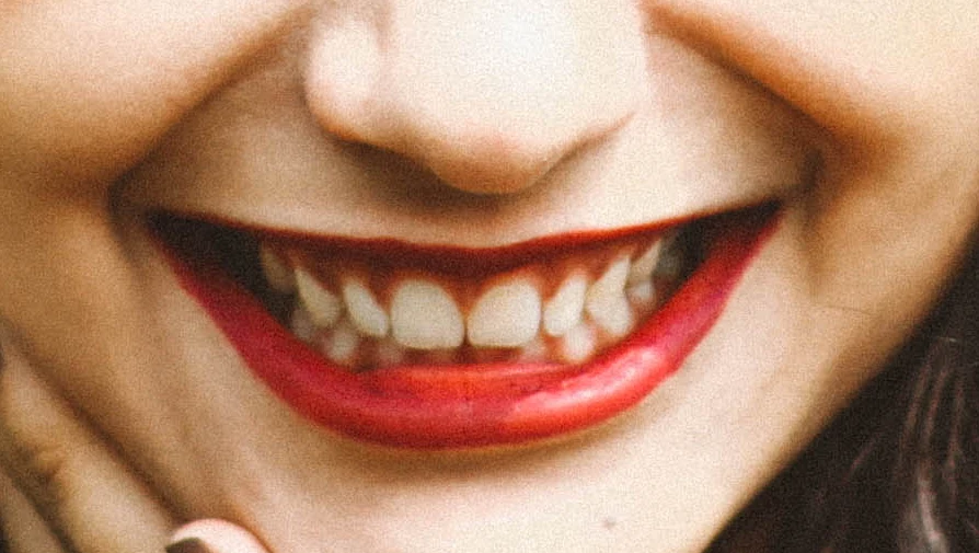 Teeth whitened, lips and gums untouched — before